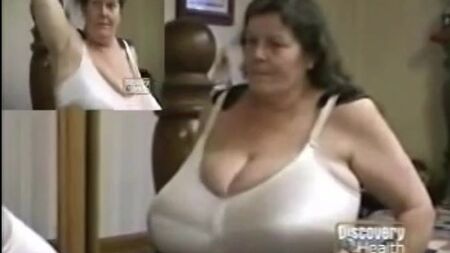 乳房肥大症